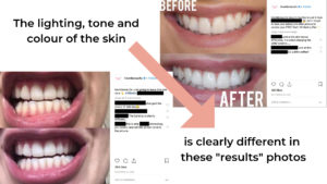 HiSmile results - edited, photoshopped, not real.