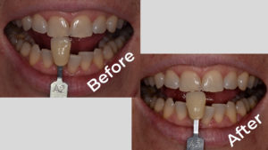 Before and after photos of Dr. Grant McGrath after using HiSmile showing no whitening effects