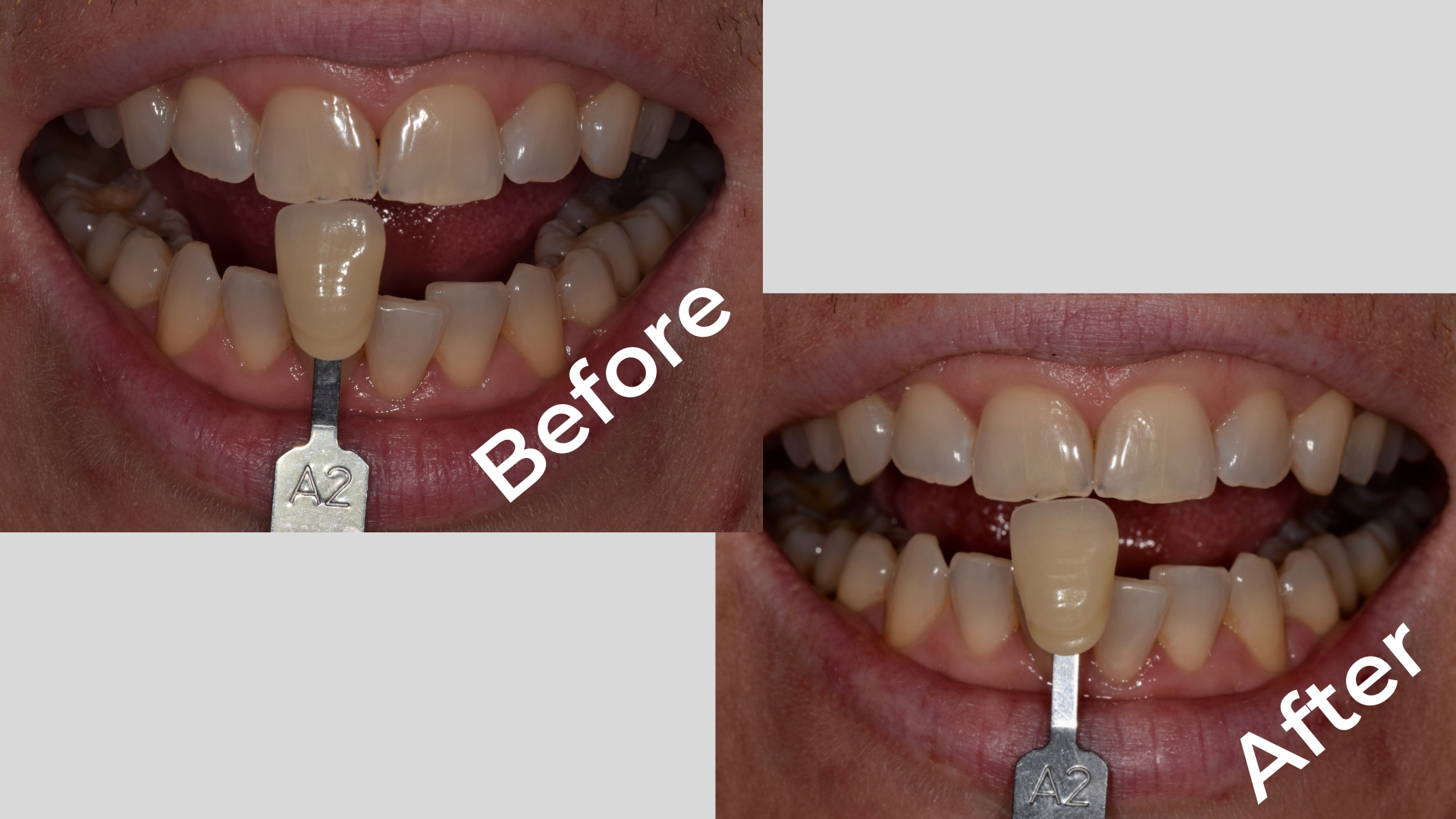 HiSmile Teeth Whitening