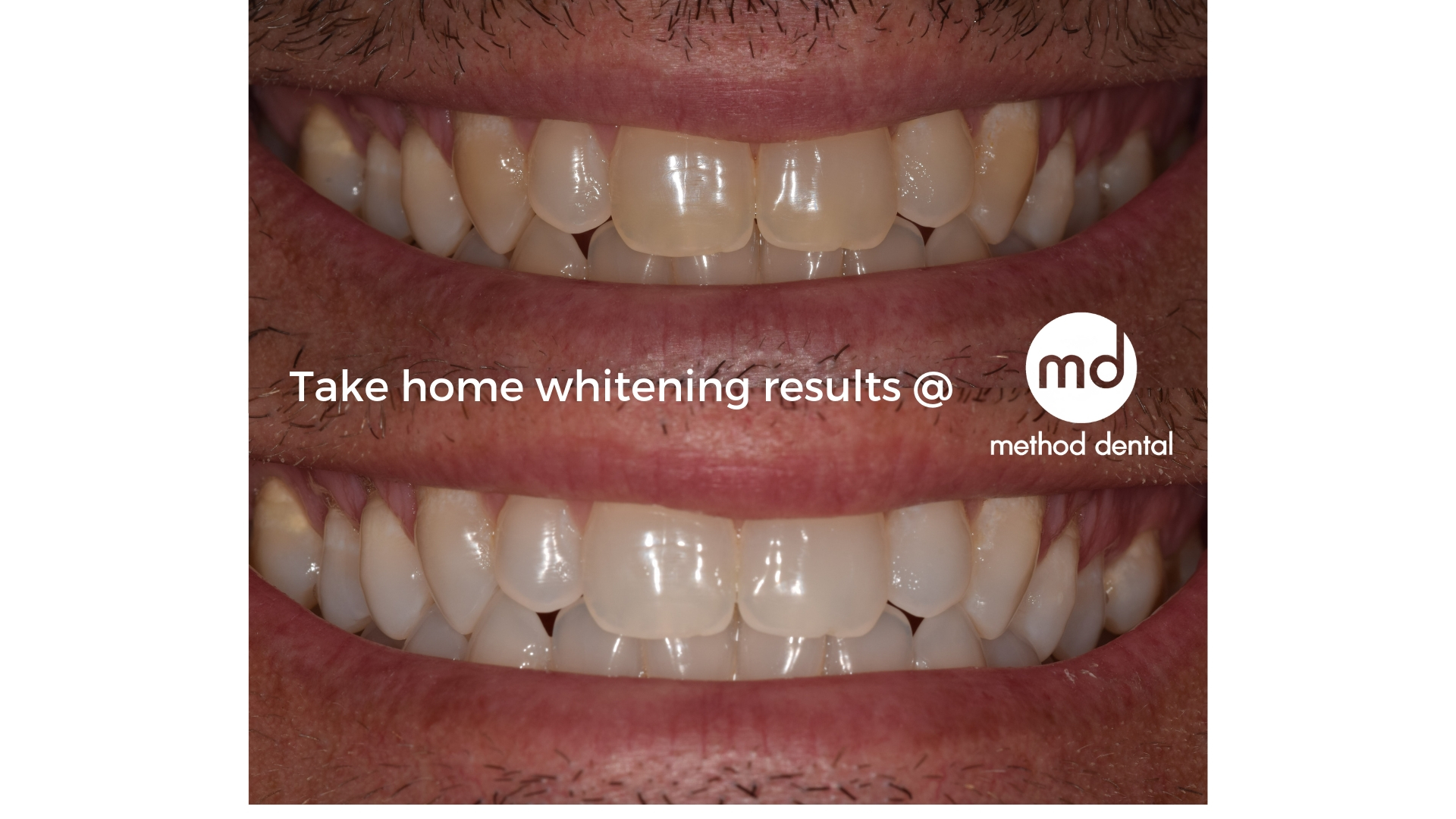 What is the Difference Between Teeth Whitening and Teeth Bleaching? - Joel  Heller DMD Rockville Centre New York