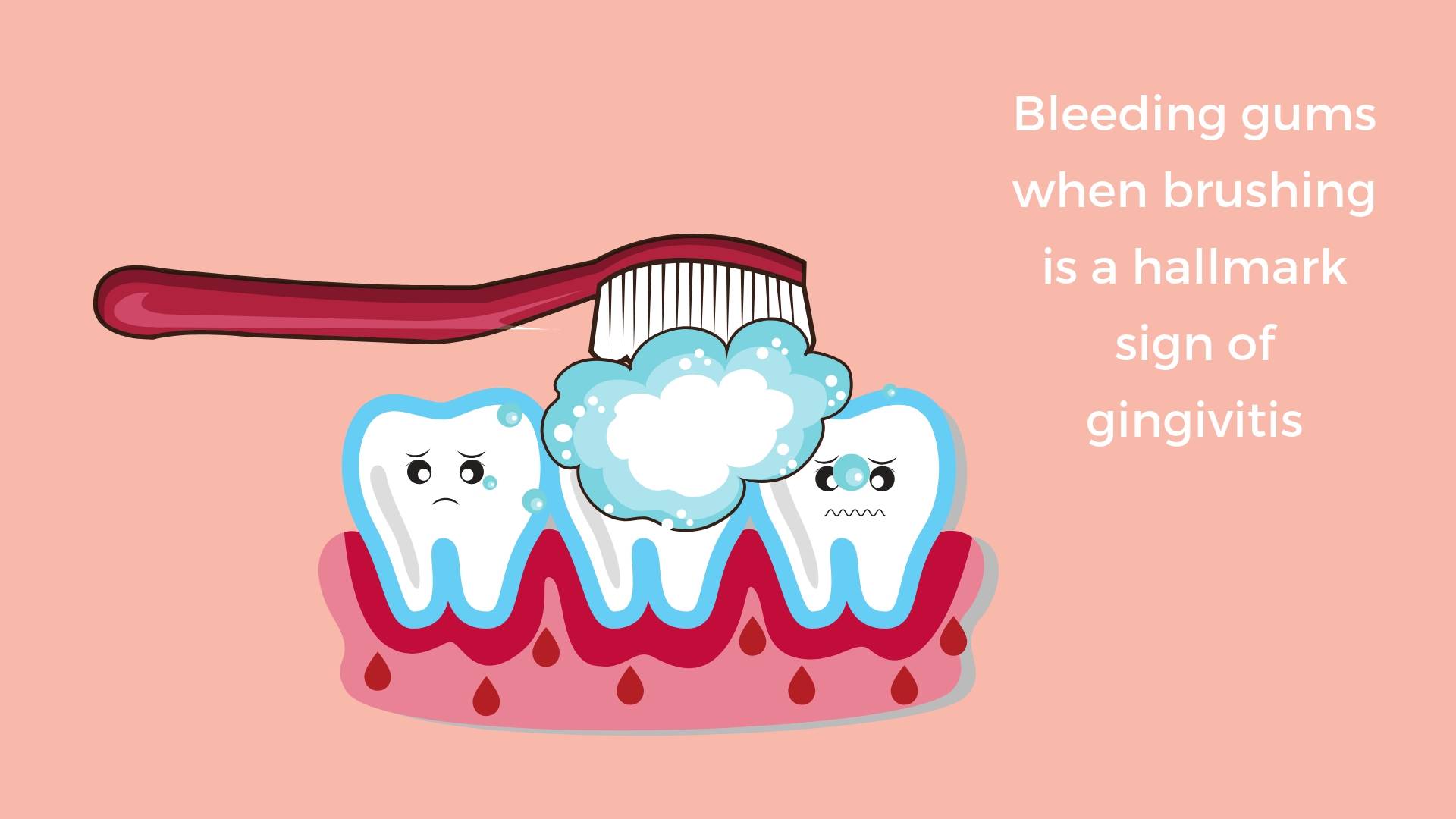 Bleeding gums during toothbrushing is a sign of gingivitis