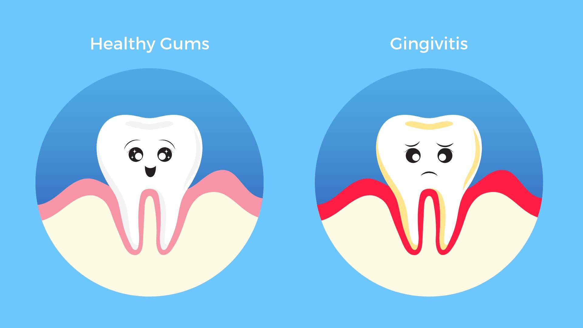 Two little teeth, one which is happy and healthy, the other which is sad because the gums around it have gingivitis