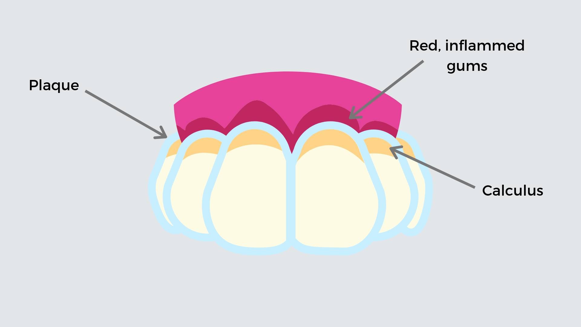 Plaque on the outside of the teeth and calculus hardened around the gums