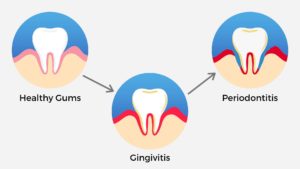 cartoons of healthy gums, gingivitis and periodontitis showing the progression of the disease