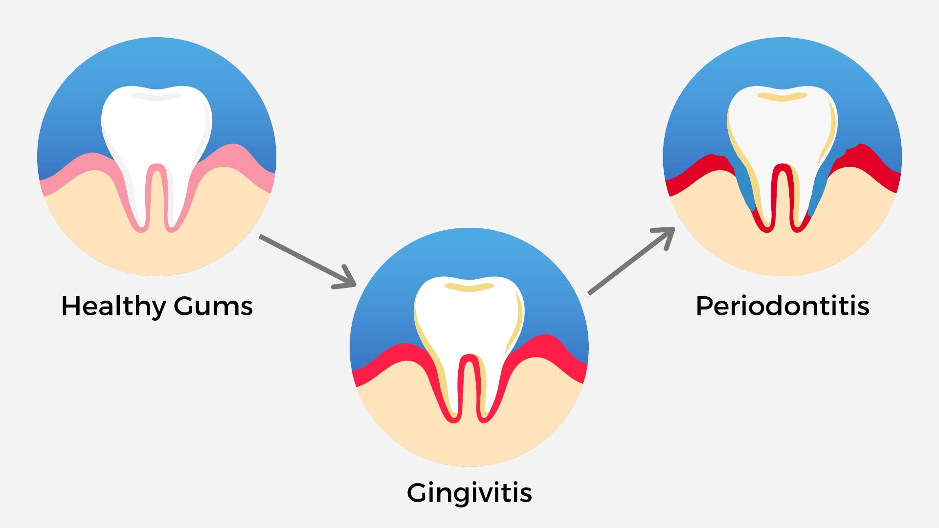 cartoons of healthy gums, gingivitis and periodontitis showing the progression of the disease