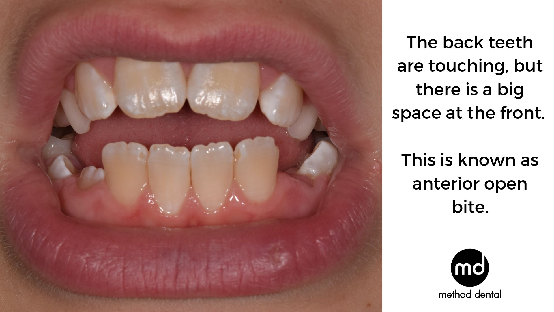 A ten year old child with anterior open bite where the back teeth are touching but the front teeth do not and there is a large gap