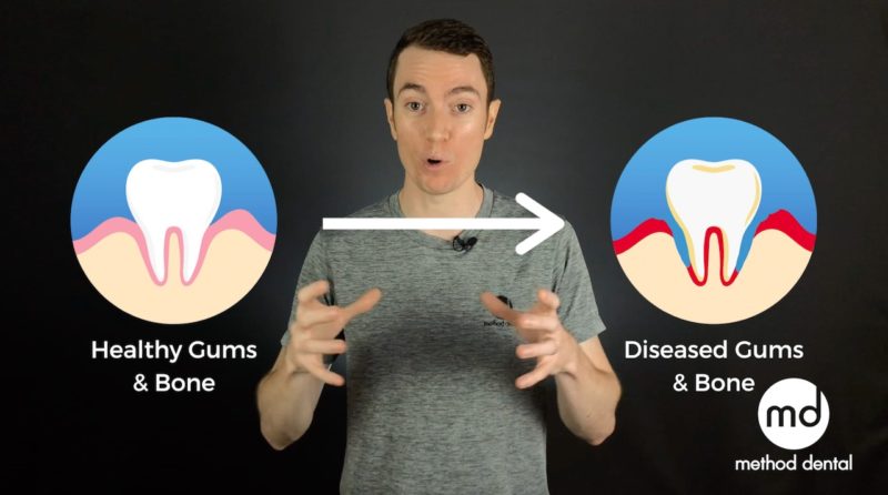 Gum Disease Management During Covid-19 Part 1