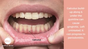 Dental calculus has formed around some teeth.