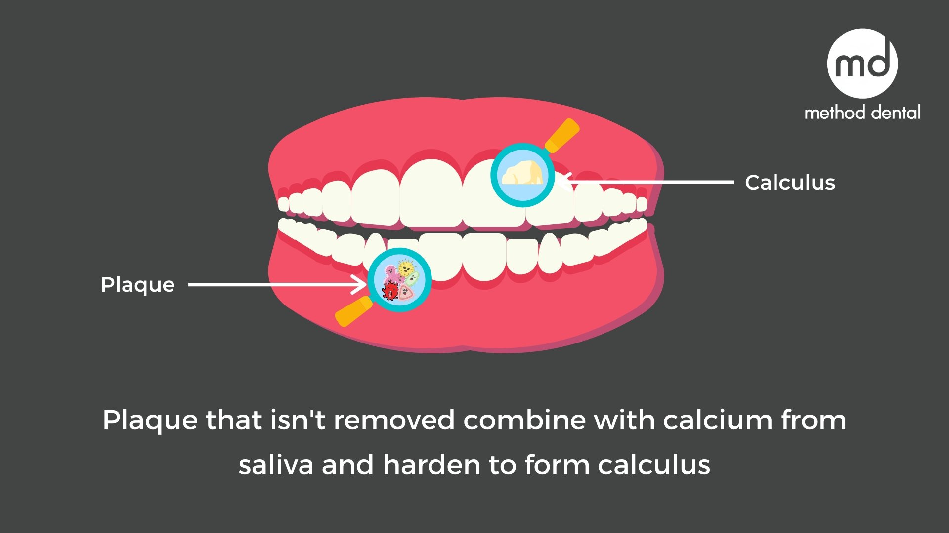 Bacteria and saliva combining to form dental calculus on teeth.