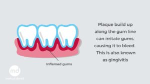 Dental plaque along the gumline causes gingivitis.