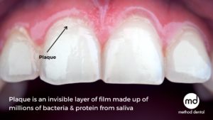 Dental plaque forms near the gumline of a tooth